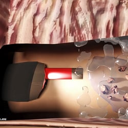 3D Animation für die Erklärung einer Nierenstein Operation