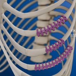 MedXpert STRACOS 3D‑Rippenklammer 3D-Animation Anwendung
