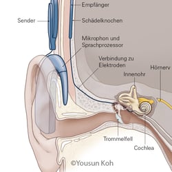 Cochlea-Implantat