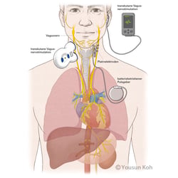Vagusnervstimulation