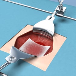 Representation of hemostasis, wound healing and sternotomy for Gelita Medical.