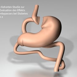 Magenbypasses bei Diabetes mellitus Typ 2 / www.klinikum.uni-heidelberg.de/Diabeteschirurgie.120580.0.html