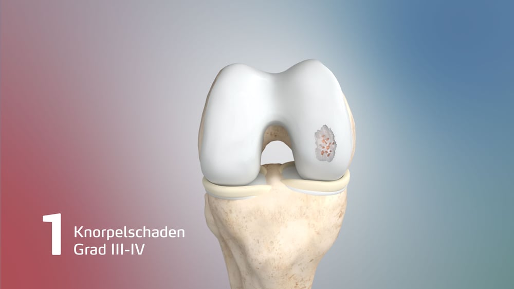 Anatomievisualisierung: Knorpelschaden Grad III-IV