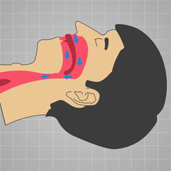 Medizinisches Schema snore-no-more