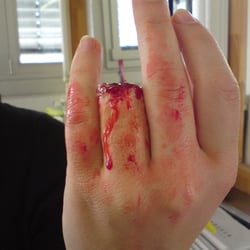 Abgetrennter Finger