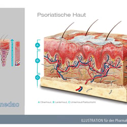 Psoriatische Hautveränderung