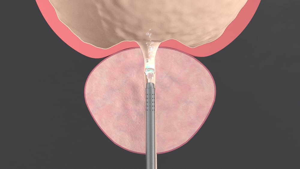 Video Prostate Laser Vaporitation