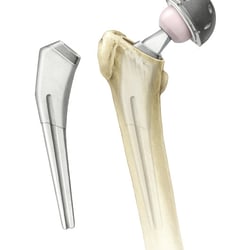 Total Hip Arthroplasty, Implant
