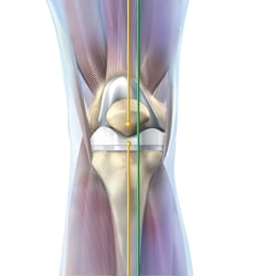 knee implant