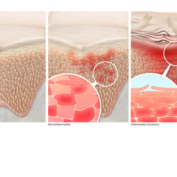 Mikroinflammation der Epidermis