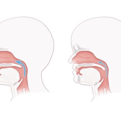 Velopharyngeal insufficiency