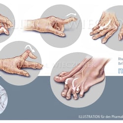 Rheumatische Arthritis, Hand, Fuß