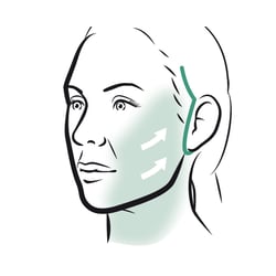 Facelift