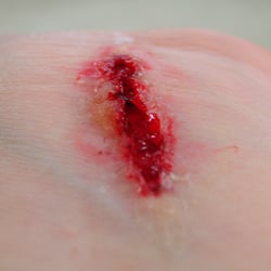 Wunde Handgelenk