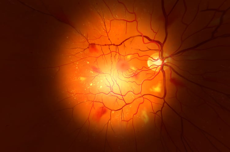 Virtual Reality App zu Erkrankung des Auges durch Diabetes