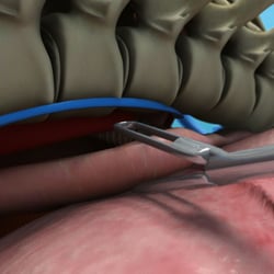 Standbild aus einem Video zum Thema „Oesophagus Resektion OP“