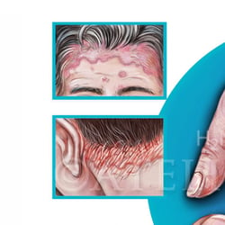 Psoriasis, Hautbefall