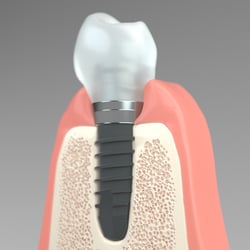 Thommen Medical – Implantologie Visuals