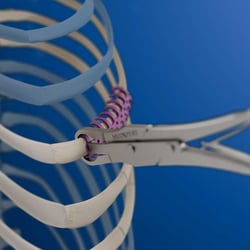 MedXpert STRACOS 3D‑Rippenklammer 3D-Animation Anwendung