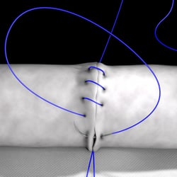 Grafik Nahtkurs, Uniklinikum Heidelberg