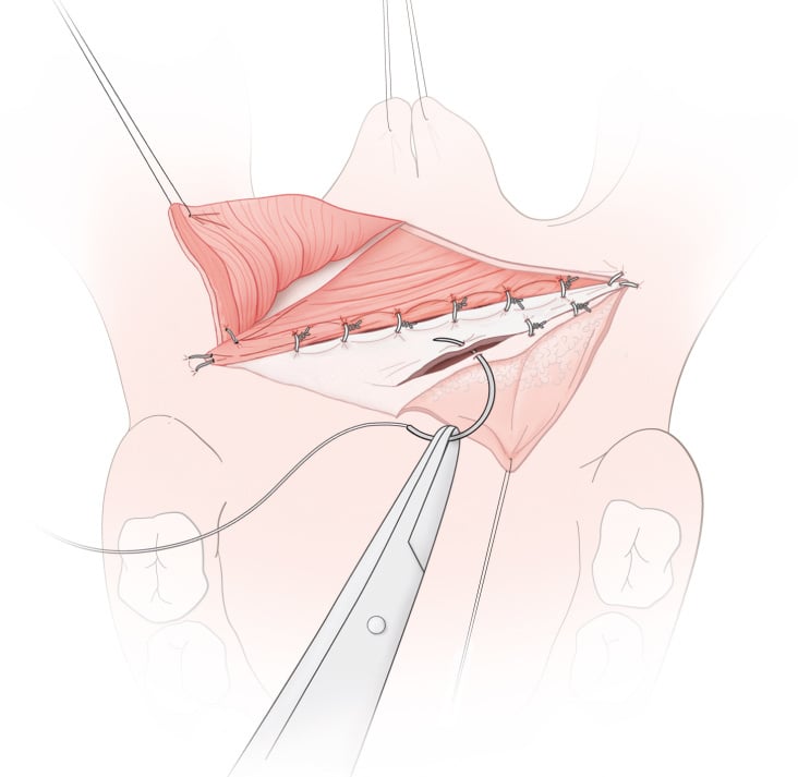 Submucous cleft palate