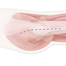 THA, antolateral approach to the hip