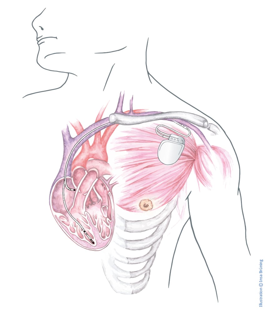Torso mit implantiertem Herzschrittmacher