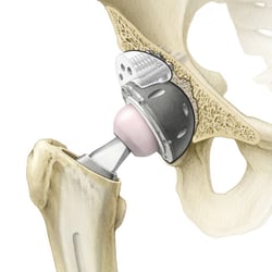 Total Hip Arthroplasty, augment