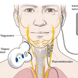 Vagusnervstimulation