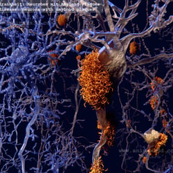 Verschiedene Phasen der Alzheimer Krankheit, Neuronen mit Amyloid-Plaques
