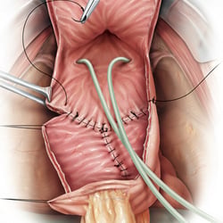 Bladder augmentation, in Zusammenarbeit mit Stephan Spitzer (Atelier für medizinische Illustration)