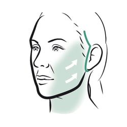Facelift