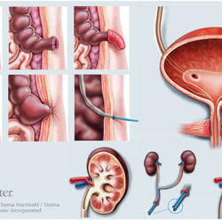 STOMA