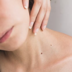 Medsanic Hechtsheim: Hautgesundheit und Prävention von Hautkrebs