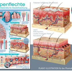 Psoriasis