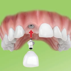 Dentales Implantat