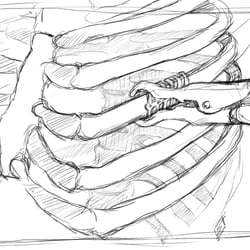 MedXpert STRACOS 3D‑Rippenklammer 3D-Animation Storyboard