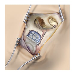 OP-Situs Innenohr-Implantat (mit Elektrode zur Übertragung elektrischer Impulse in  die Gehör-Schnecke (Cochlea)