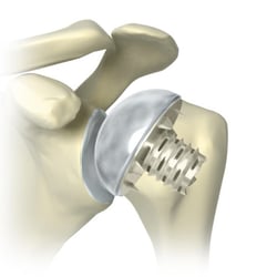 orthopädisches Schulterimplantat
