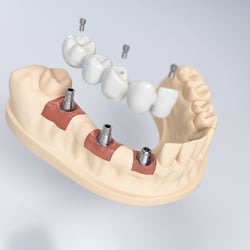 Thommen Medical – Implantologie Visuals