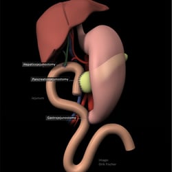 Schema ppWhipple für Chirurgie