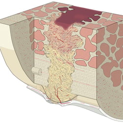 Phase 2: Granulationsgewebe