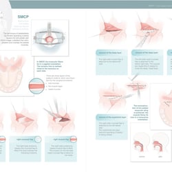 Submucous cleft palate