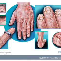 Psoriasis, Hautbefall