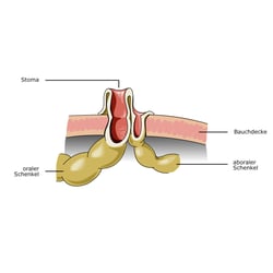 Künstlicher Darmausgang (Enterostoma doppelläufig)
