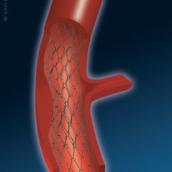 Medizinische Illustration eines Stent