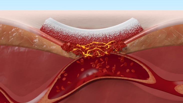 Representation of hemostasis, wound healing and sternotomy for Gelita Medical.