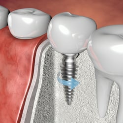 Implantat bp