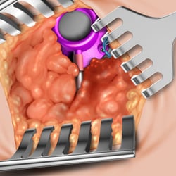 Port-Implantation