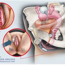 BS Female Cuff System – Inkontinenz